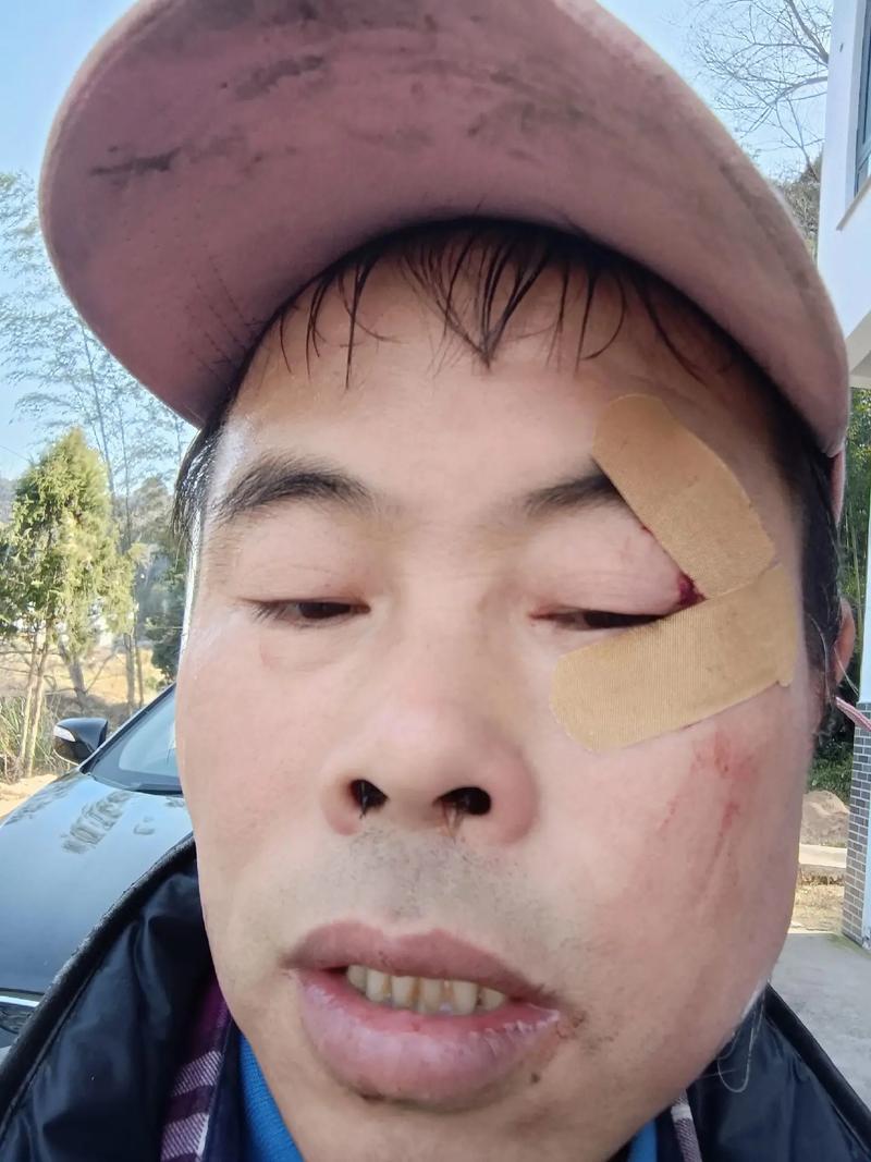 被精神病患挖伤双眼,被精神病患挖伤双眼怎么办